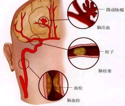 十八味杜鵑丸能治腦梗塞嗎