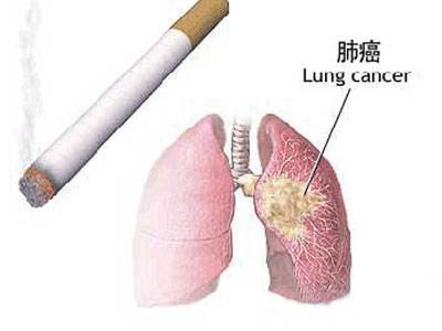 二十五味肺病丸可治肺癌吗